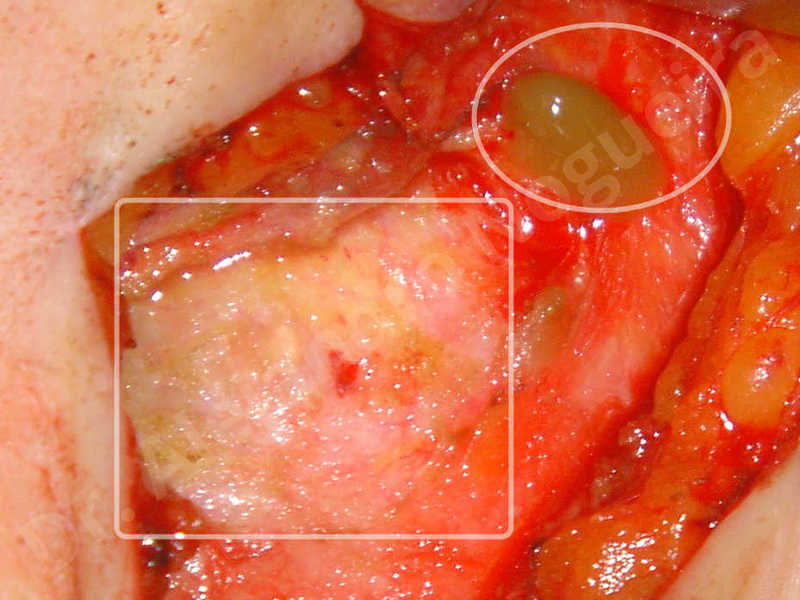 Se puede hacer endodoncia con infeccion